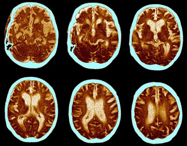 ГЛП-1 пилула не успева да успори напредовање Алцхајмерове болести у клиничком испитивању ГЛП-1 пилула не успева да успори напредовање Алцхајмерове болести у клиничком испитивању