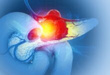 Нови третман са троструким лековима зауставља рак панкреаса у својим стазама, открива студија на мишевима