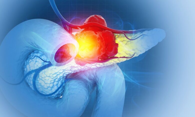 Нови третман са троструким лековима зауставља рак панкреаса у својим стазама, открива студија на мишевима