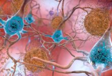 Зашто људи могу имати оштећење мозга повезано са Алцхајмером, али без симптома