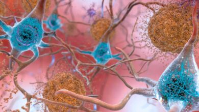 Зашто људи могу имати оштећење мозга повезано са Алцхајмером, али без симптома Зашто људи могу имати оштећење мозга повезано са Алцхајмером, али без симптома