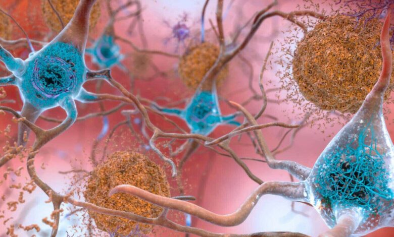 Зашто људи могу имати оштећење мозга повезано са Алцхајмером, али без симптома
