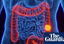 Шта је колоректални рак и да ли се може спречити? | Па заправо
