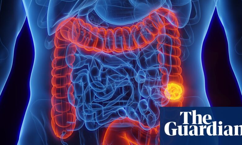 Шта је колоректални рак и да ли се може спречити? | Па заправо Шта је колоректални рак и да ли се може спречити? | Па заправо