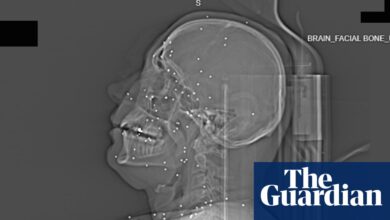 ‘Намерно гађање виталних делова тела’: рендгенски снимци снимљени након протеста у Ирану откривају степен катастрофалних повреда | Иран