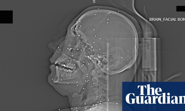 ‘Намерно гађање виталних делова тела’: рендгенски снимци снимљени након протеста у Ирану откривају степен катастрофалних повреда | Иран