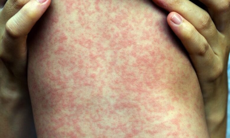 Епидемија морбила у Јужној Каролини повезана са отицањем мозга код деце