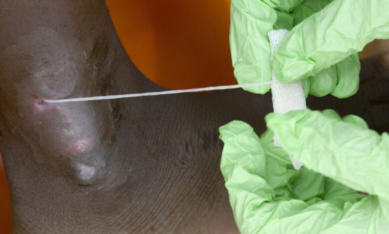 Гвинејски црв на путу да буде друга искорењена људска болест; само 10 случајева у 2025