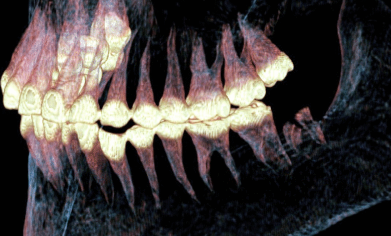 2.500 година стар ‘примитивни протет’ пронађен на вилици мумифициране Скитске жене која је преживјела сложену операцију вилице