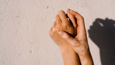 Руксолитиниб: Знаковита крема од витилига циља имуне ћелије које ометају пигментацију