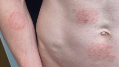 Гљивица полно преносивих инфекција постаје пријатна у САД