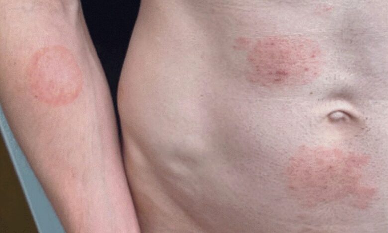 Гљивица полно преносивих инфекција постаје пријатна у САД