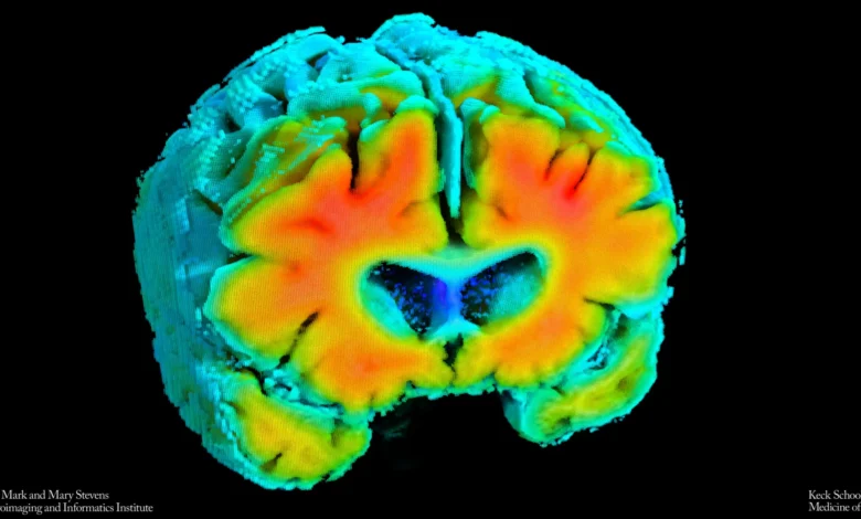 Алцхајмерова болест може почети тихим падом крвотока у мозгу