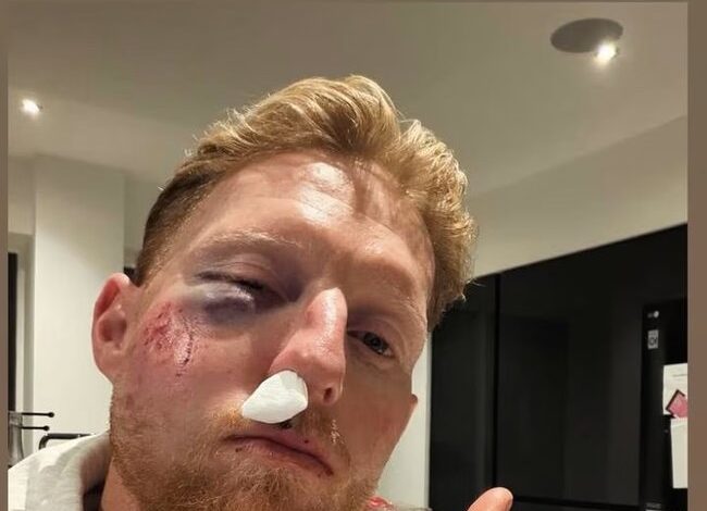 Звезда енглеског крикета Бен Стоукс задобио је тешке повреде лица у чудном инциденту на тренингу