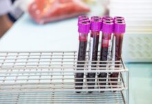 Једноставан тест крви могао би вам на крају рећи када Алцхајмерова болест долази