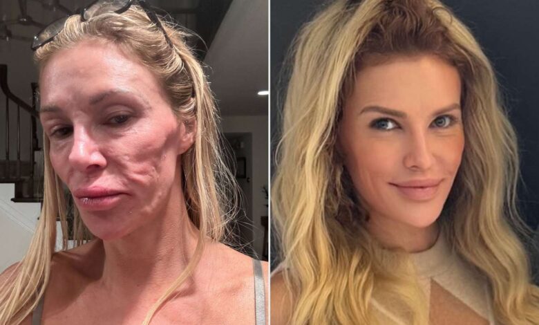 Бренди Гланвил открива шта је изазвало њен паразит на лицу Бренди Гланвил открива шта је изазвало њен паразит на лицу