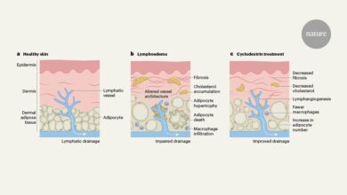 Чишћење заробљеног холестерола могло би ублажити лимфедем