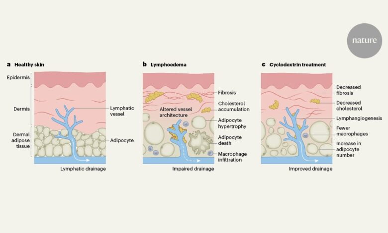 Чишћење заробљеног холестерола могло би ублажити лимфедем