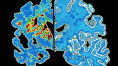 Тест крви обећава када ће се појавити симптоми Алцхајмерове болести