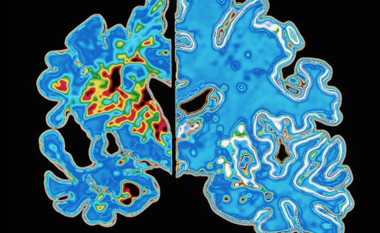 Тест крви обећава када ће се појавити симптоми Алцхајмерове болести