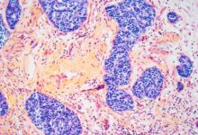 Да ли лекови за гојазност изазивају тешку компликацију? Шта каже наука