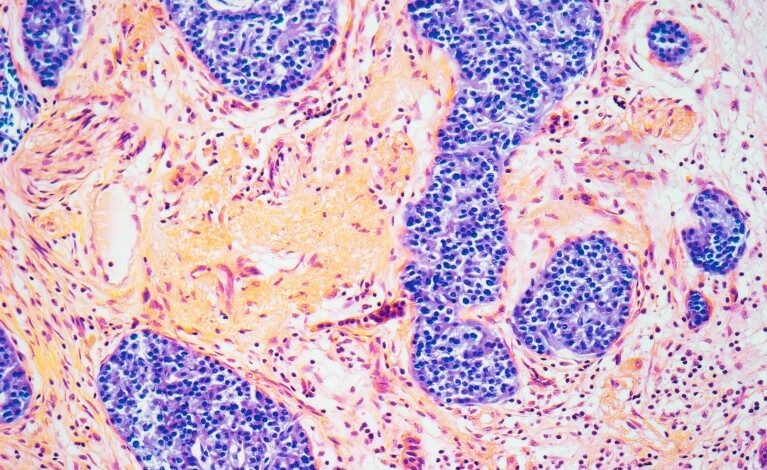 Да ли лекови за гојазност изазивају тешку компликацију? Шта каже наука