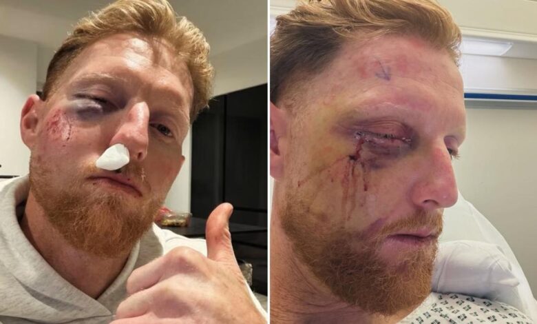 Бен Стокес се подсмева сопственом изубијаном лицу из болничког кревета после операције