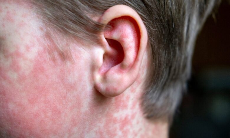 ЦДЦ одбија да преузме кривицу за спирале морбила ван контроле ЦДЦ одбија да преузме кривицу за спирале морбила ван контроле