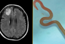 Дијагностичка дилема: Паразит који никада раније није виђен код људи стоји иза женине инфекције плућа, оштећења органа и заборава