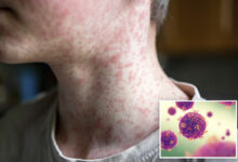 Потврђен четврти случај малих богиња у округу ЛА, заједница позвана да предузме мере предострожности