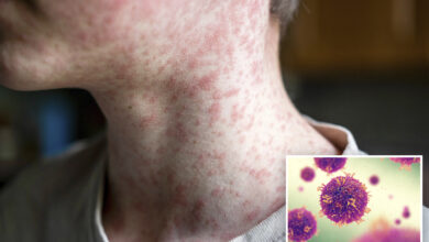 Потврђен четврти случај малих богиња у округу ЛА, заједница позвана да предузме мере предострожности